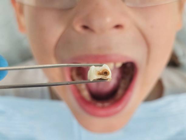 Best Dental Abscess Treatment in Clayton, CA